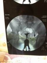 藻巢吃了对试管婴儿的好处,吃藻巢要提前几个月？